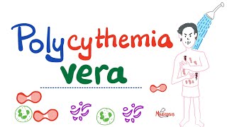 Polycythemia Vera PV  Myeloproliferative Neoplasm MPN  Erythrocytosis  Hematology [upl. by Sabanrab]