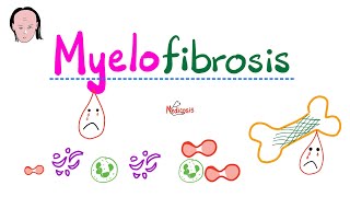 Myelofibrosis  causes symptoms diagnosis treatment pathology [upl. by Child]