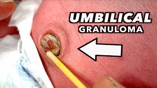 LARGE UMBILICAL GRANULOMA Cauterized with Silver Nitrate  Dr Paul [upl. by Lewin]