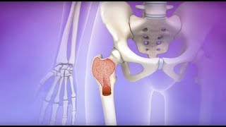 Understanding Myelodysplastic Syndromes MDS [upl. by Eenad536]