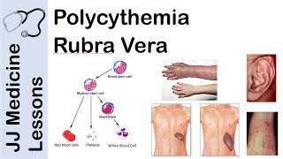 Polycythemia Rubra Vera  Pathophysiology Symptoms Diagnosis and Treatment [upl. by Pestana25]