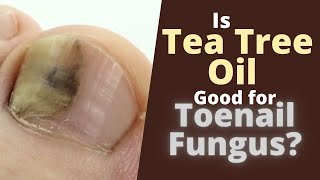 Does Tea Tree Oil Kill Toenail Fungus Is tea tree oil good for toenail fungus [upl. by Eon411]